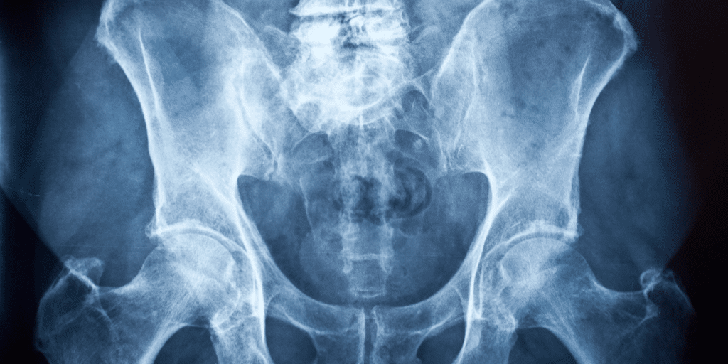 This is the cause of pelvic pain