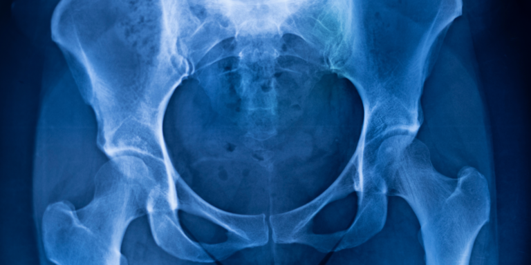 Pelvic, Pelvis pelvic pain and the pelvis